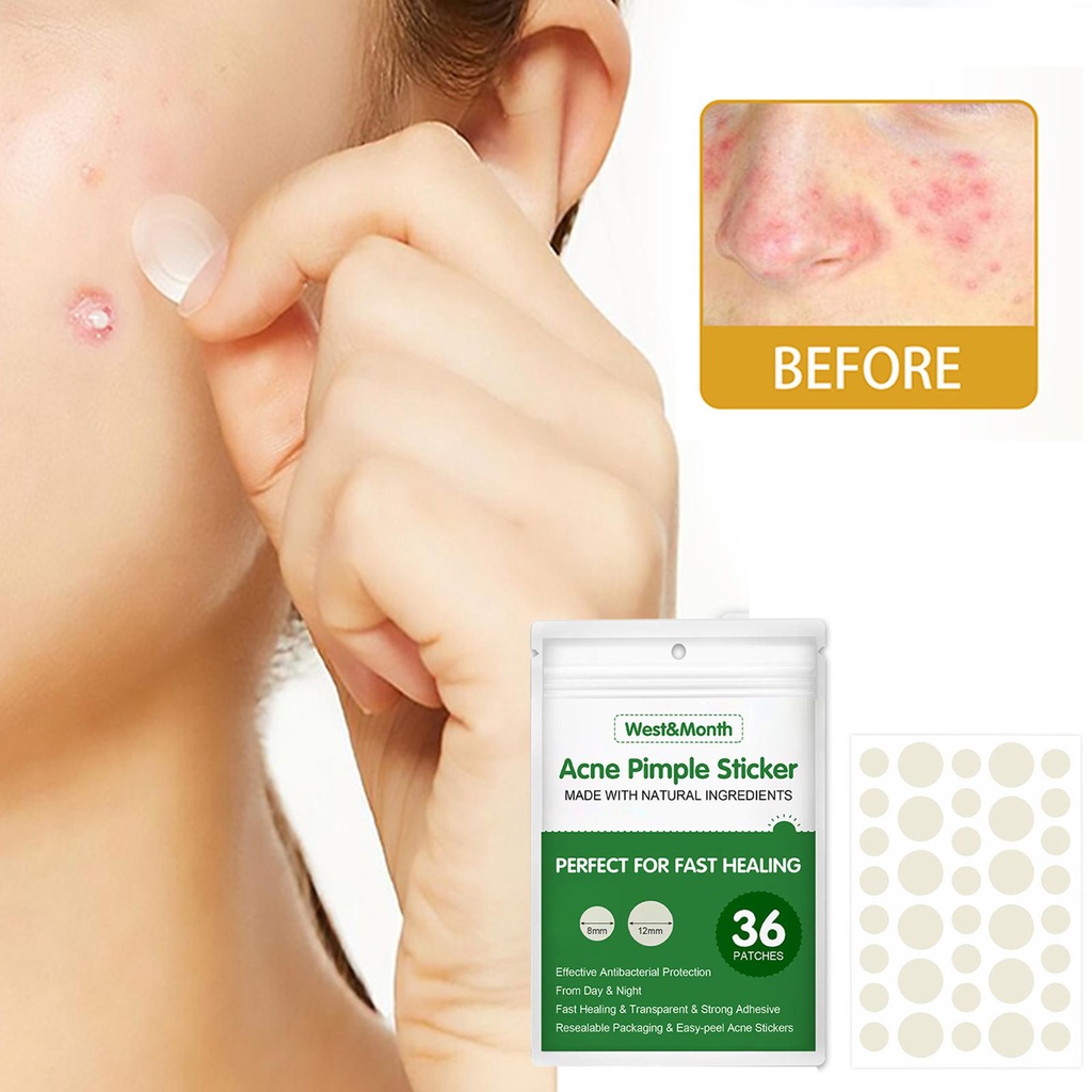 Acne Pimple Patch Stickers Acne Treatment Pimple Remover Spot Facial ...