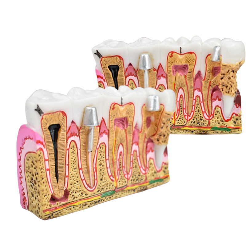 Dental Caries Model Tooth Model Oral Teaching Model Teeth Model Dental ...