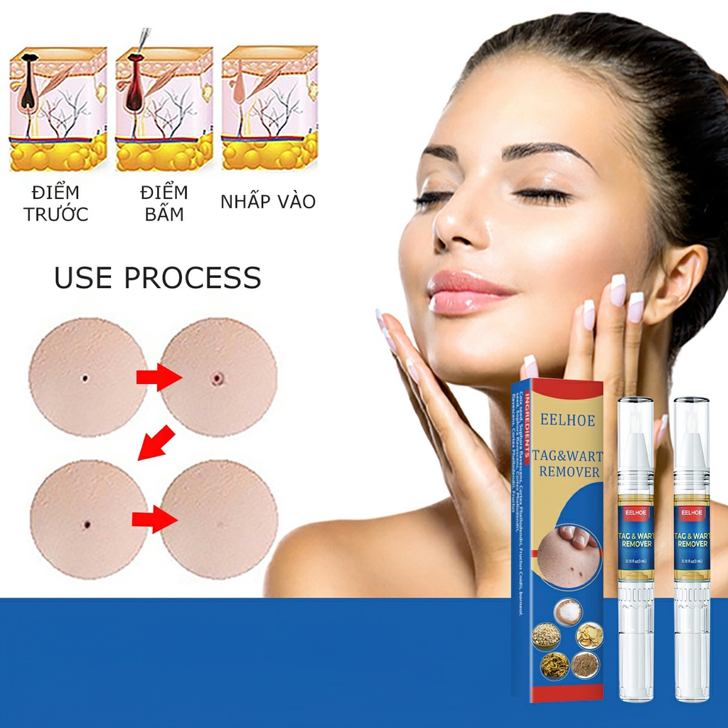 Remove Moles On The Face, Freckles Of Acne, Keloids, Perennial Pitting