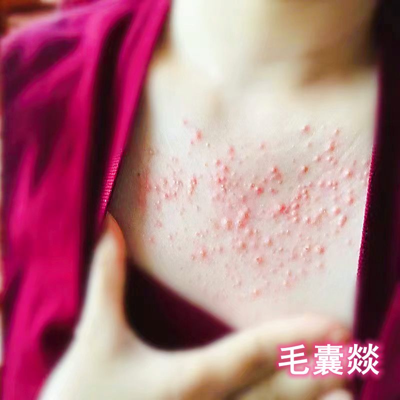 Breast Acne Breast Acne Breast Acne Breast Acne Bacteria Infection Red