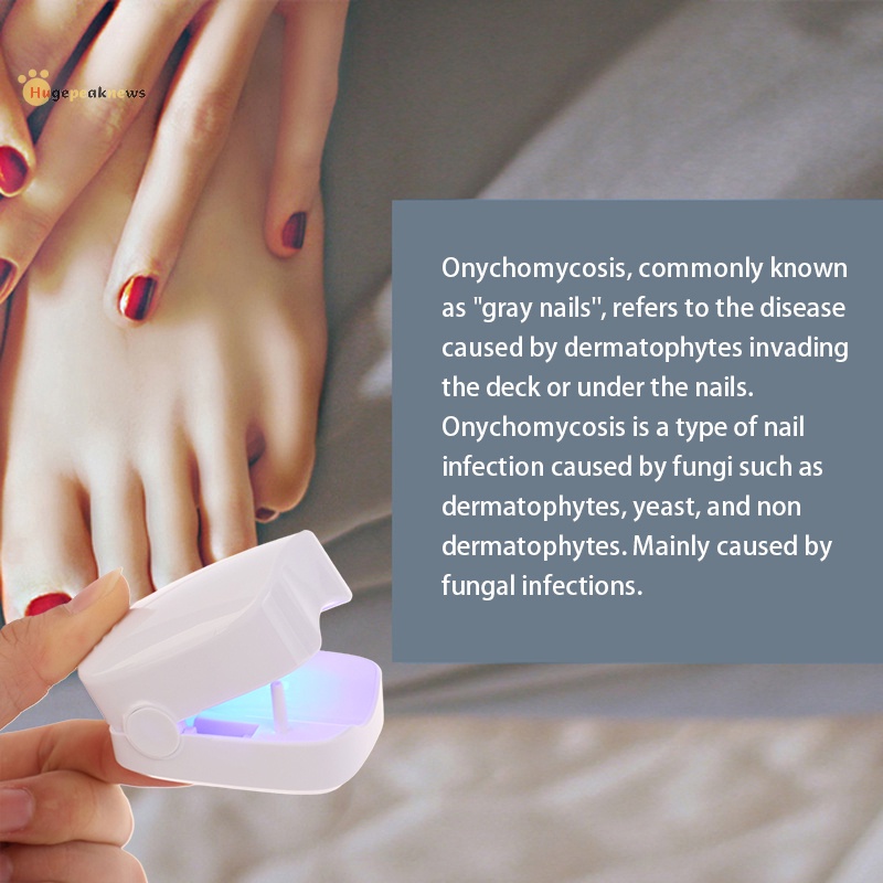 hugepeaknews Ultraviolet Fingernails Toenails Onychomycosis Remover