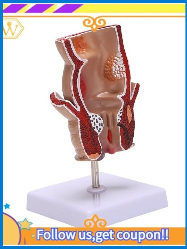 Anatomy Model Human Rectal Hemorrhoid Lesion Model Hemorrhoid Fistula Fistula Fissure Pathology Teaching Model