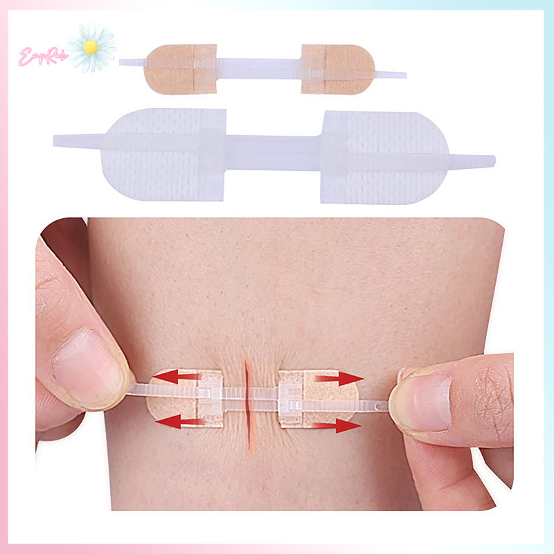 EMCH> Zipper Tie Wound Closure Patch Hemostatic Patch Wound Fast Suture ...