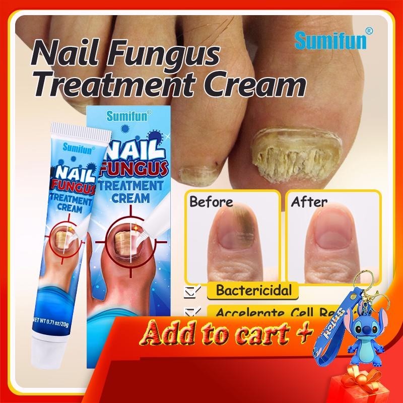 Effective Nail Repair】Sumifun Nail Fungus Treatment Nail Anti Fungal