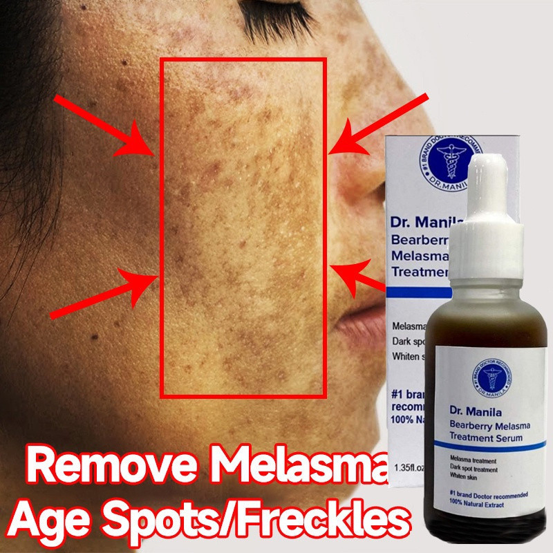 DR Manila Bearberry Melasma Treatment Serum ( No.1 Treatment For ...