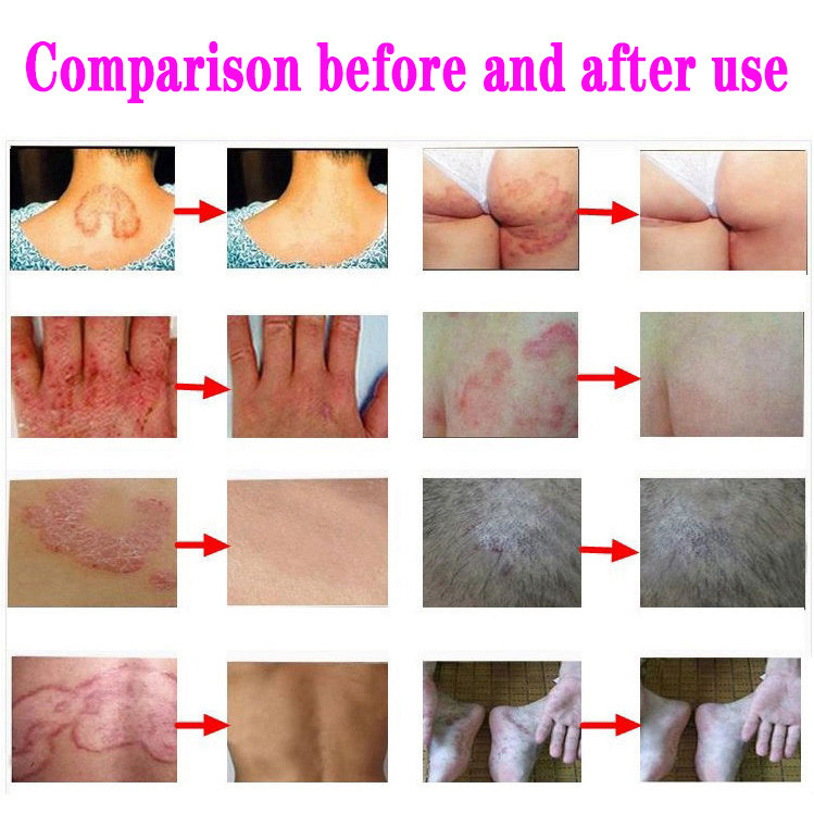 F12 Anti-itch cream Fast relief 30g man skin care cream antibacterial ...