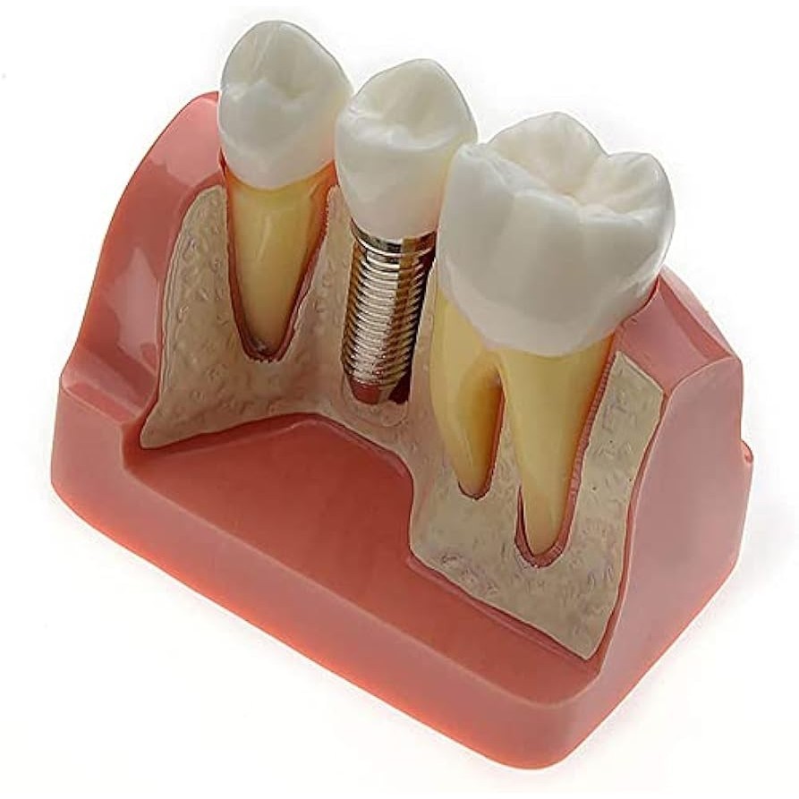 Dental Implant Analysis Crown Bridge Study Model – Removable Teeth For Lab & Dentistry Training