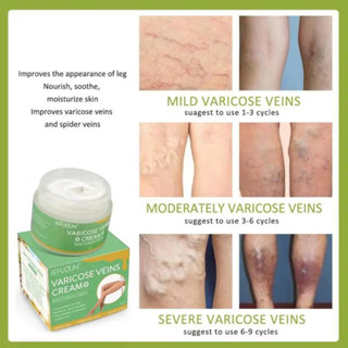 AH | Varicose Vein Remover ORIGINAL Effective Treatment Cream Spider ...