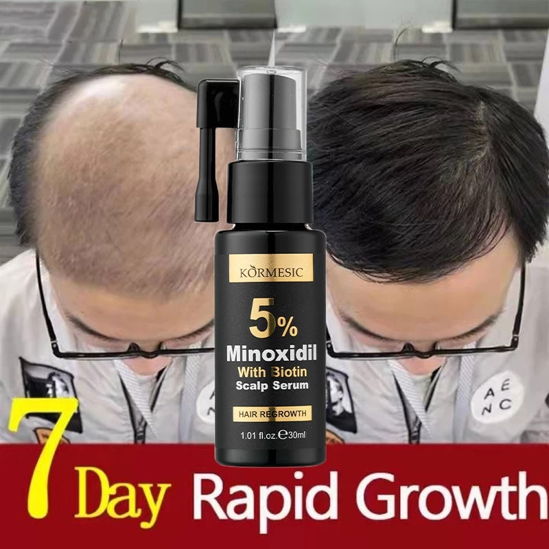 Minoxidil 5% Hair Grower with Biotin Serum for Hair Loss Treatment ...