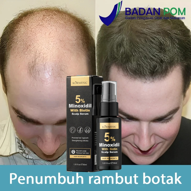 Minoxidil 5% Hair Serum with Biotin Hair Grower Anti Hair Loss Anti ...