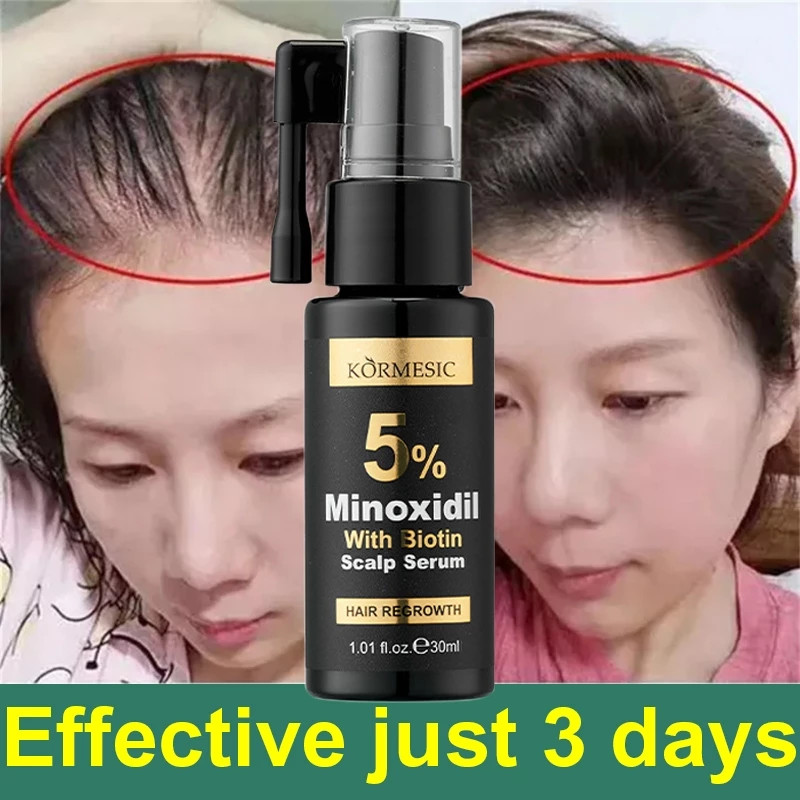 5% Minoxidil Hair Grower Serum with Biotin Regrowth Anti-Dandruff Anti ...