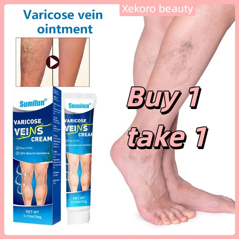 Effective Varicose Vein Removal cream Original Vein Treatment Cream ...