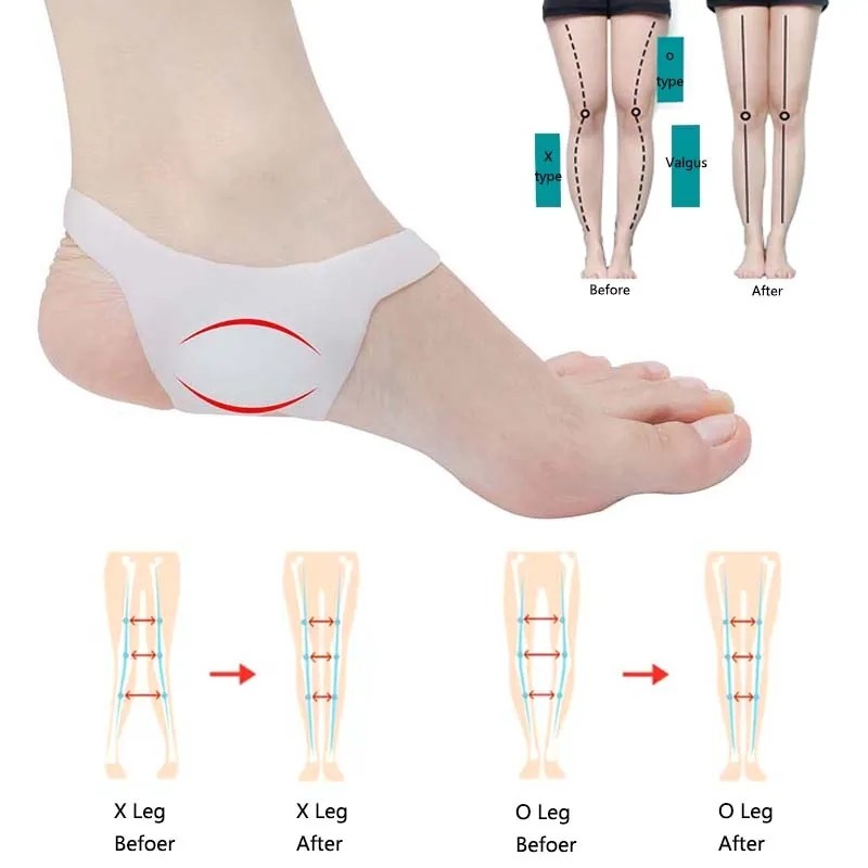 1 Pair Silicone Insole Orthopedic Insoles O-Type Leg Foot Valgus ...