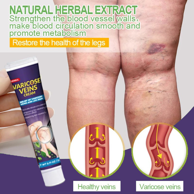 Varicose Veins Relieve Cream Herbal Ointment For Varicocele To Relieve ...