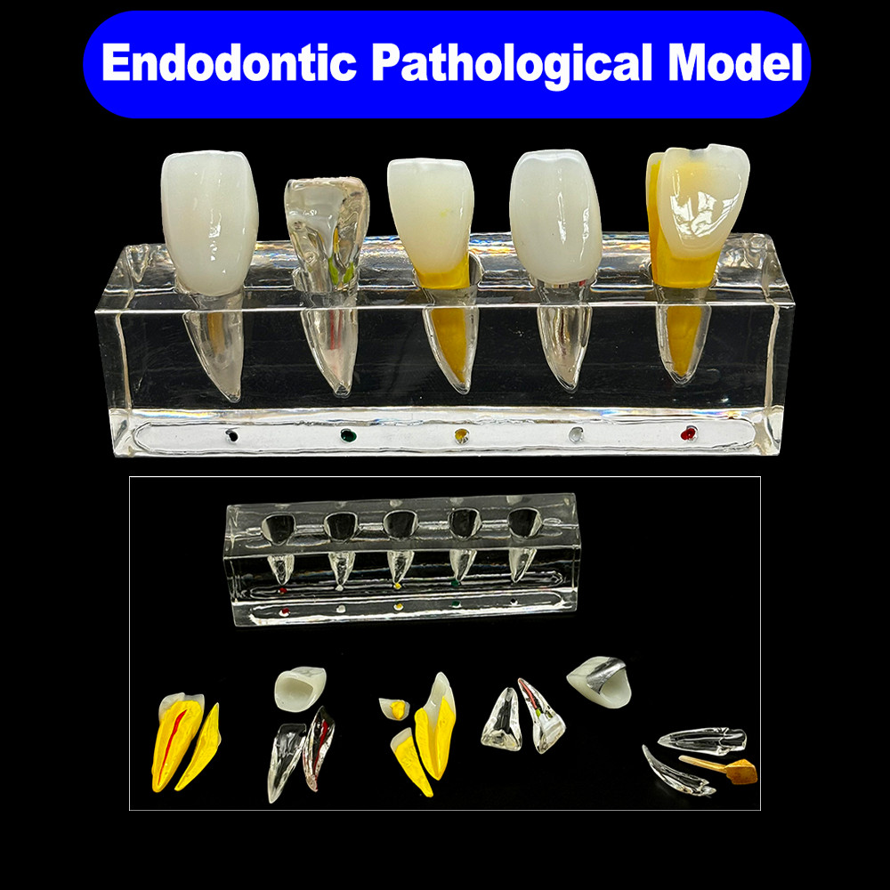 Dental Teaching Model Endodontic Pathological Anterior Front Labial ...