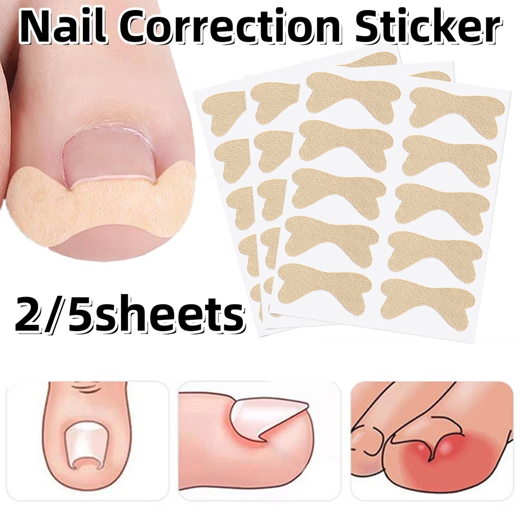 2/5Sheets Ingrown Toenail Corrective Stickers Foot Care Treatment ...
