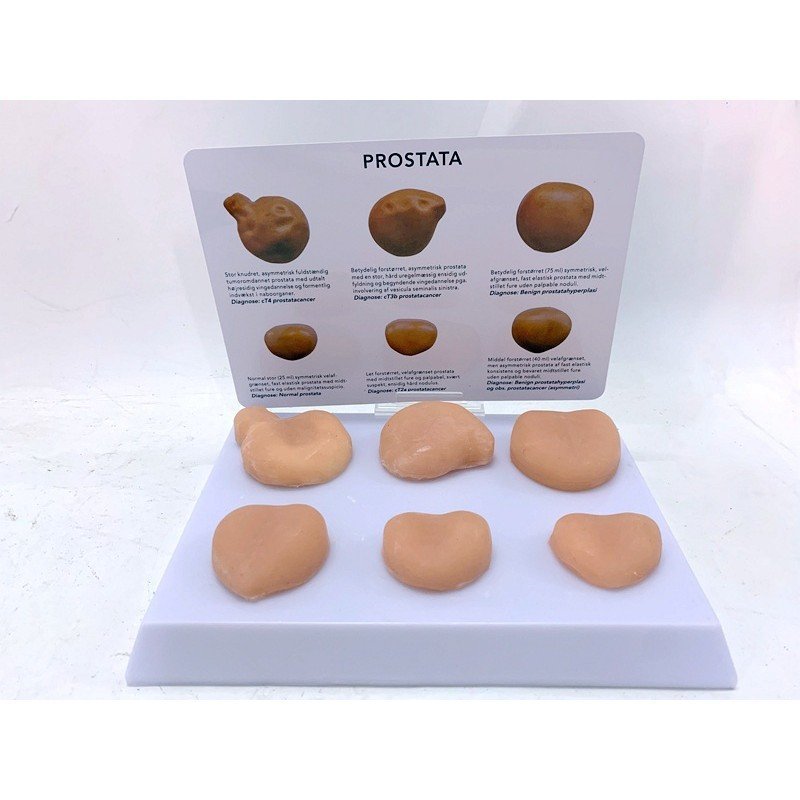 Prostate Model Prostate Tumor Anatomical Structure Model Human Anatomy ...