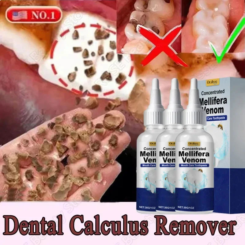 Tooth Whitening Essence Tooth Calculus Removing Dental Plaque Bad ...