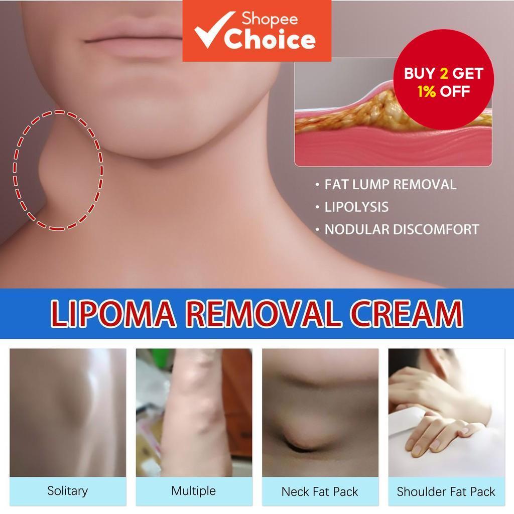 New Lipoma Removal Cream, Relieve Cream for Inflammation, Fibroids ...
