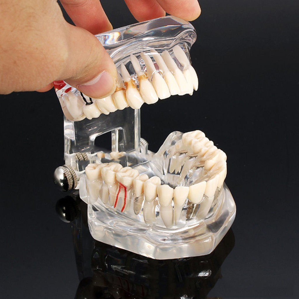 Dental Model Restoration Bridge Tooth Teaching Analysis Removable Teeth ...