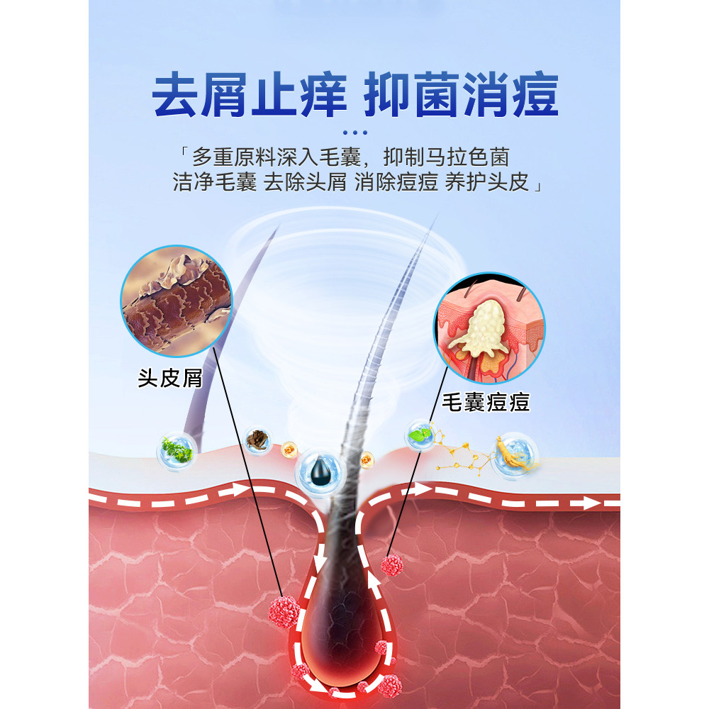 Folliculitis Spray Dedicated Head Anti-Itch Shampoo Antibacterial Head ...