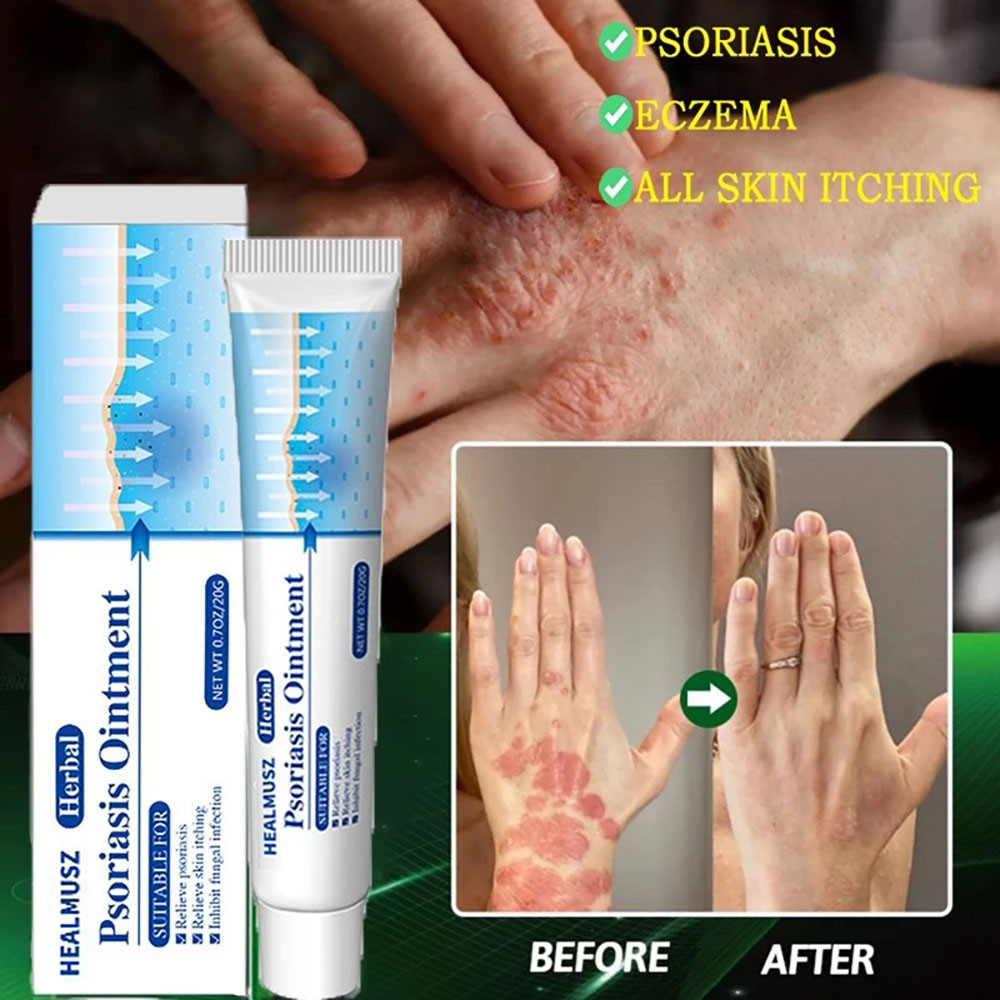 Eczema Psoriasis Cream Herbal Antibacterial Anti Itch Relief Eczema ...