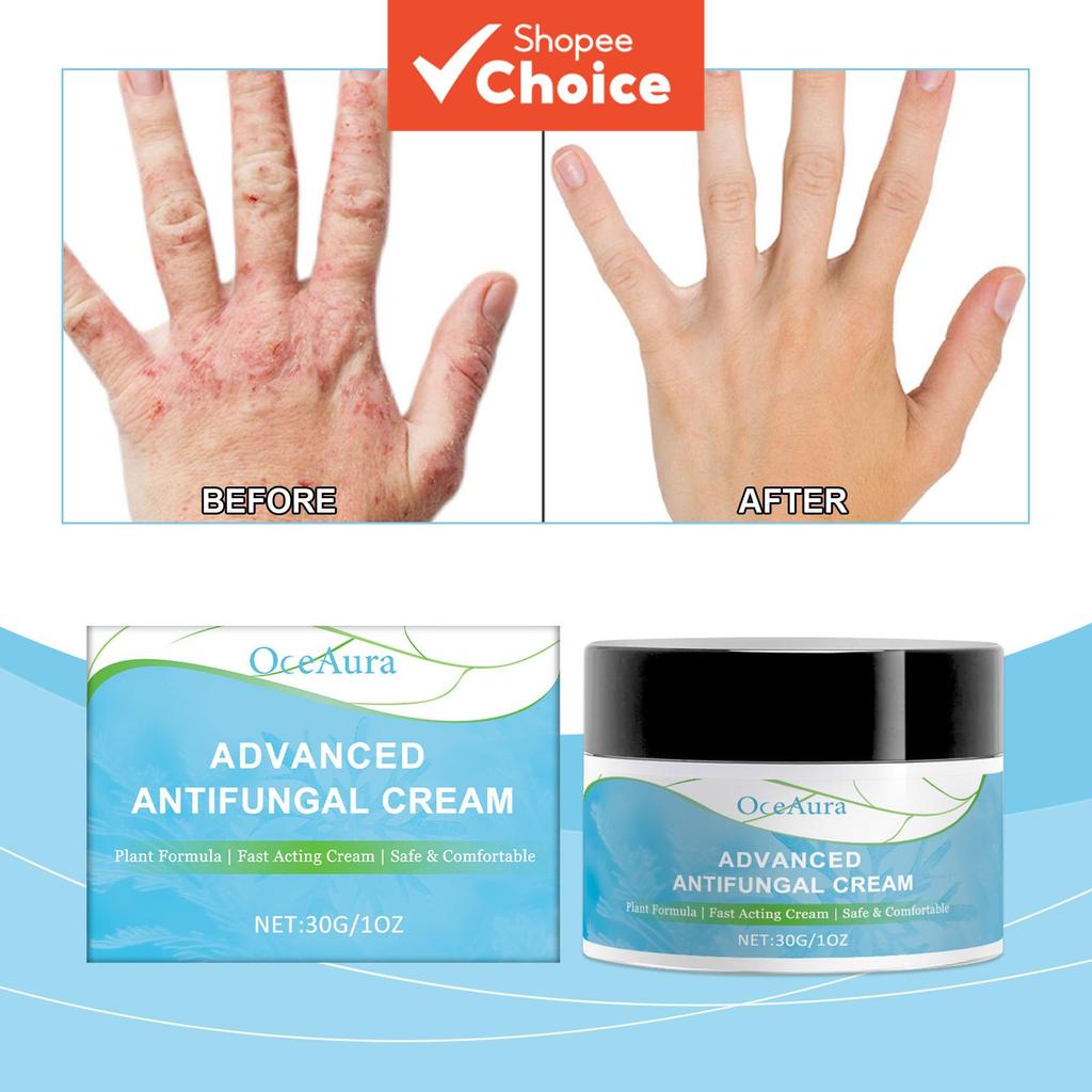Anti Fungal Ringworm Fungisol Antifungal Psoriasis Antifungal Cream 30g ...