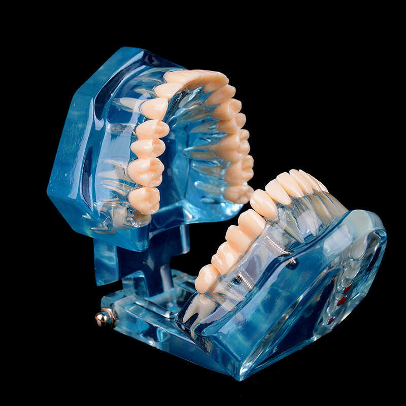 Dental 1 With Bridge Restoration Case Movable Implant Tooth Model ...