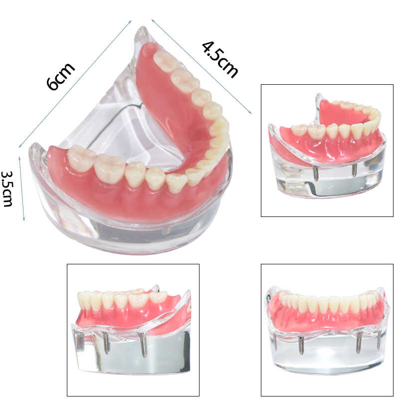 LY Dental Implant Teeth Model 4 Implants Overdenture Removable Bridge ...