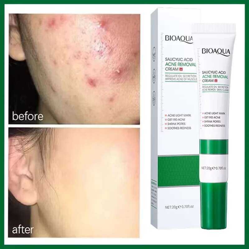 Acne Cream | Spot Treatment & Face Creams - Target