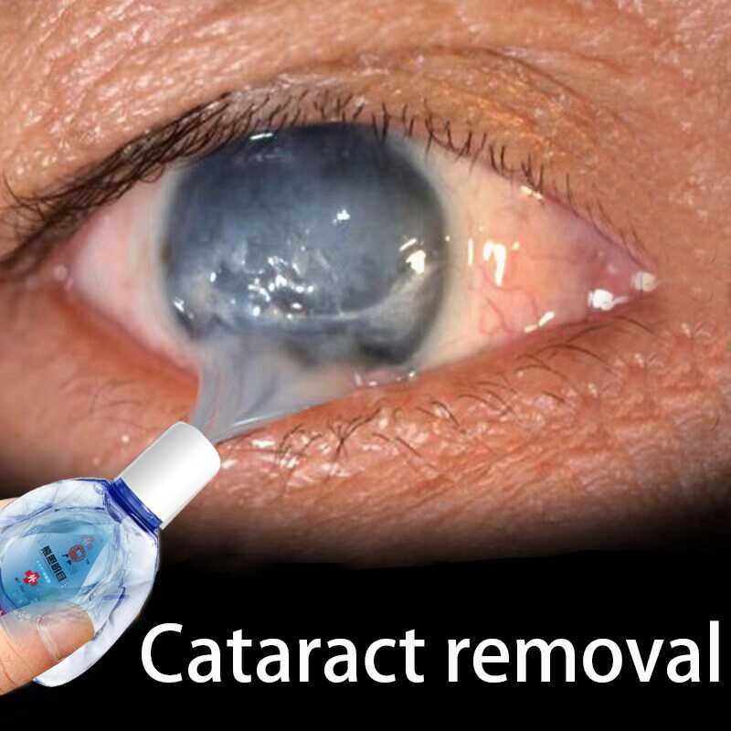 Cataract eye drops 15ml Eye Drops for dry eye Eye Wash Care Eye Washer
