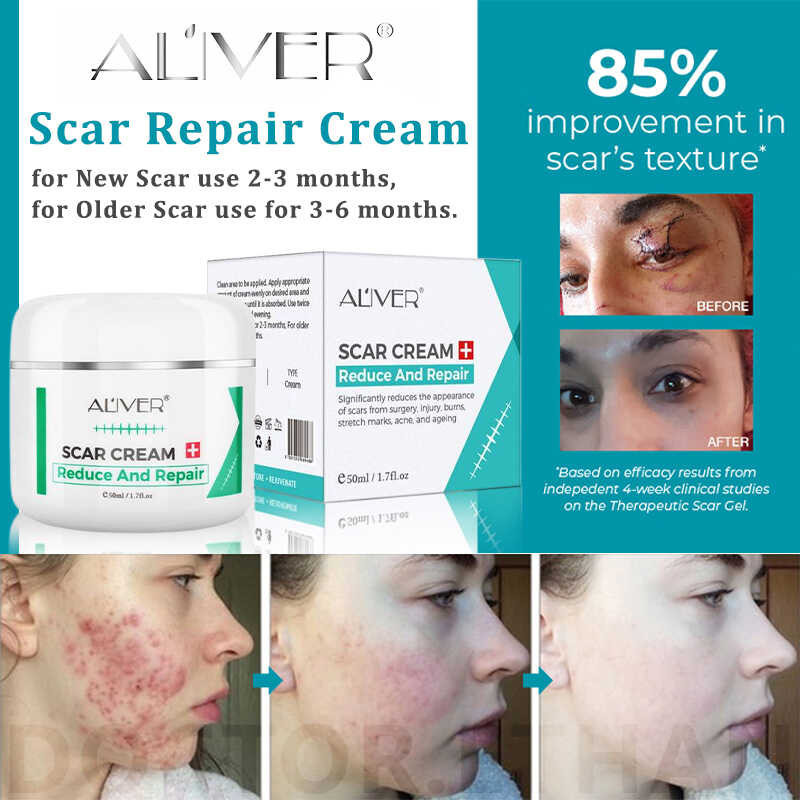 Original Aliver Cream Remove Scars for Old on Leg Scar Gel - Pantanggal ...