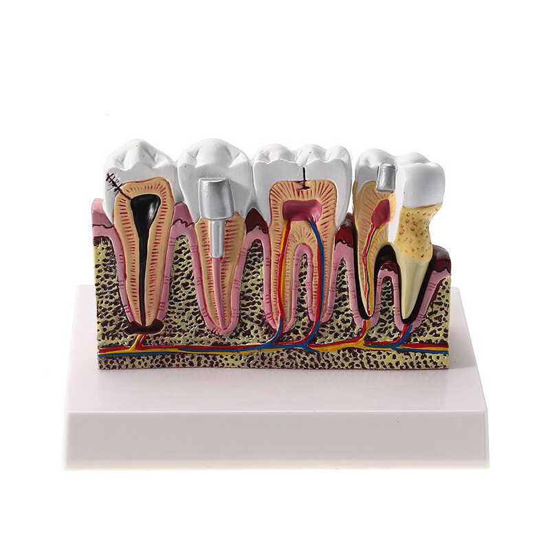 LY ♛ Anatomical Structure Model Standard Dental Oral Teeth Ching Model ...