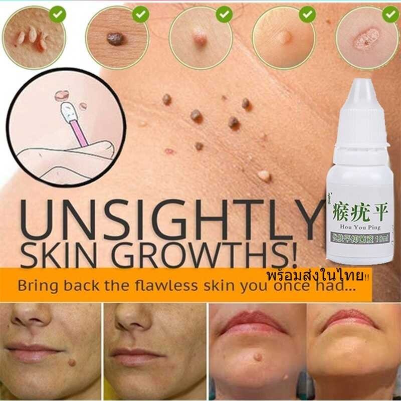 Warts Remover Original Warts Removal Serum Kulogo Remover Skin Tags ...