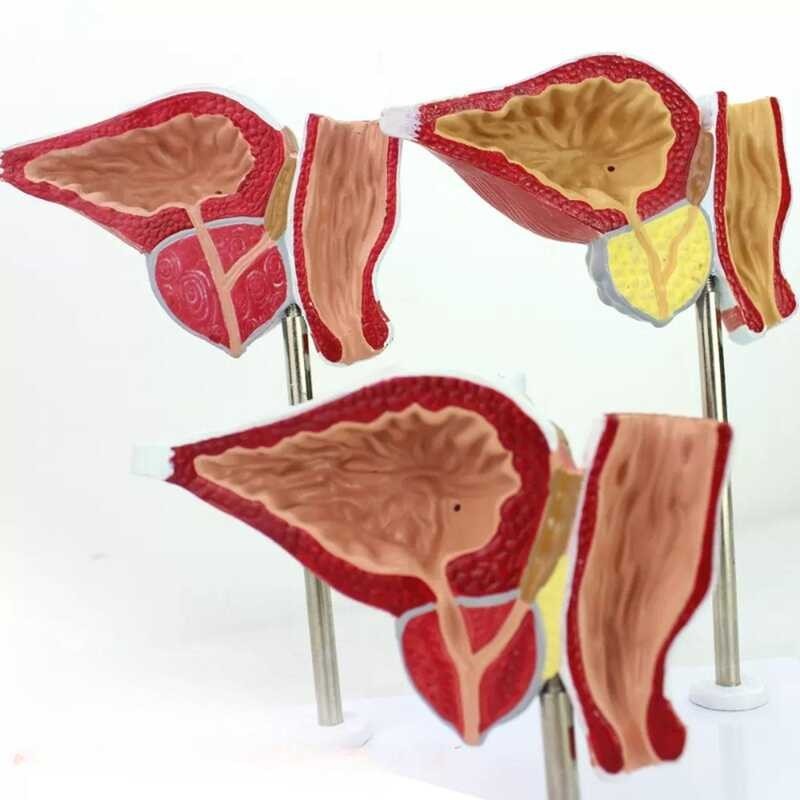 LY ♛ Human Prostate Normal Hyperplasia Carcinoma Model School | Shopee ...