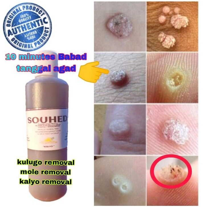 souhed 300ml | kulugo removal kalyo removal mole removal | Shopee ...