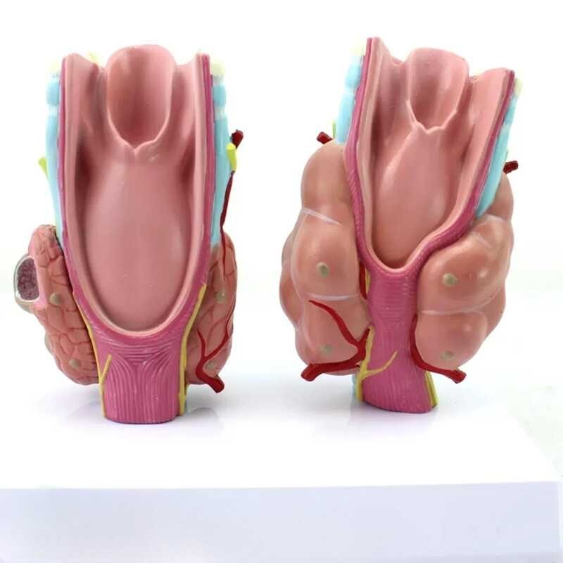 LY ♛ PVC Human Thyroid Pathology Tumor Thyroid Cancer Model Ching Model ...