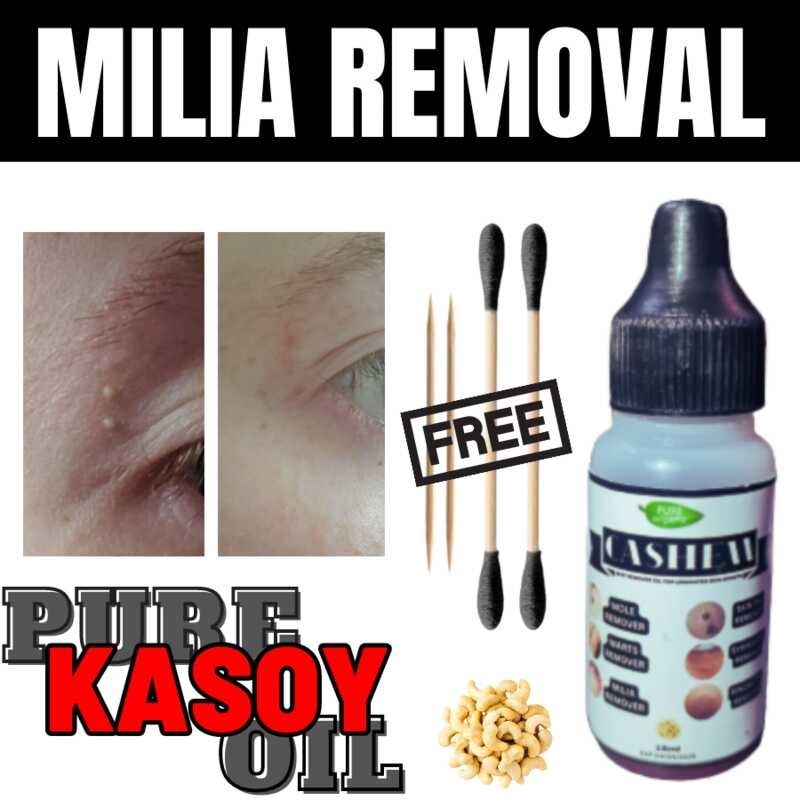 MILIA REMOVAL CASHEW OIL , milia removal , milia cream remover , milia