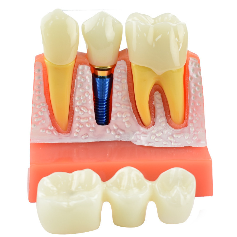 Sarini Dental Implant Model With Removable Crown & Bridge - For Student Training, Patient Education