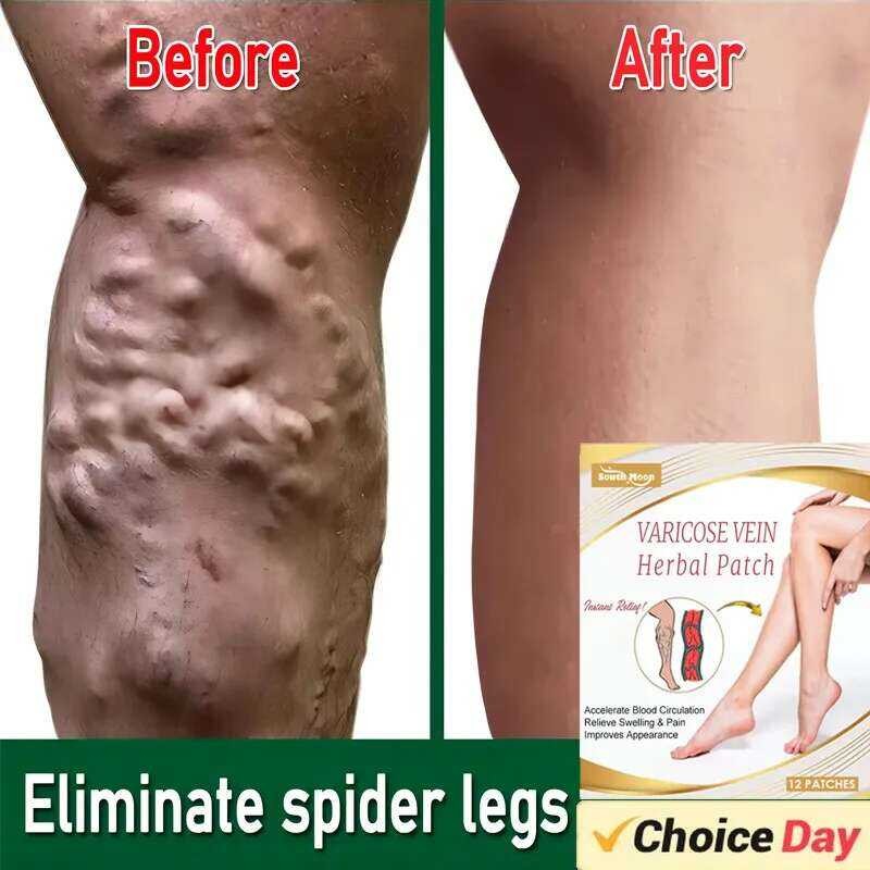 Effective Varicose Vein Relief Sticker Eliminate Vasculitis Phlebitis ...