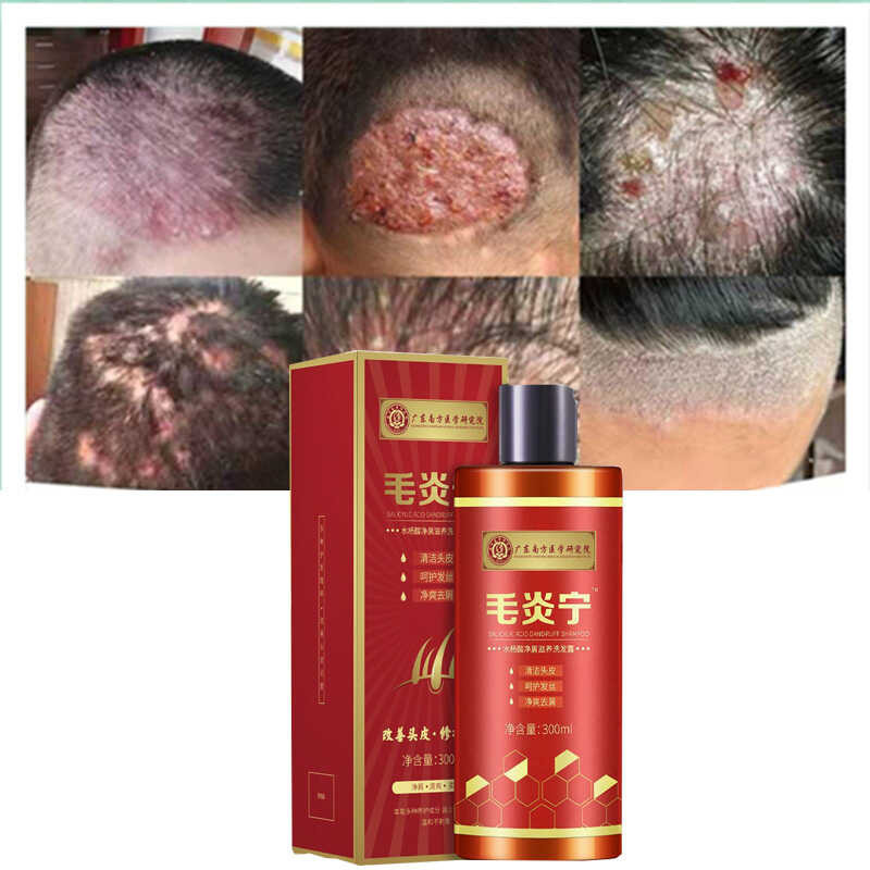 Hair Psoriasis Seborrheic Treatment Eczema Compound Herbal Shampoo Anti Dandruff Dermatitis