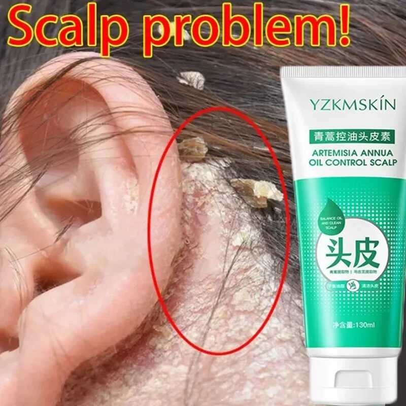 130ml Scalp Cleaning Shampoo Dandruff Seborrheic Follicles Antibacterial Anti Itching Mites Oil