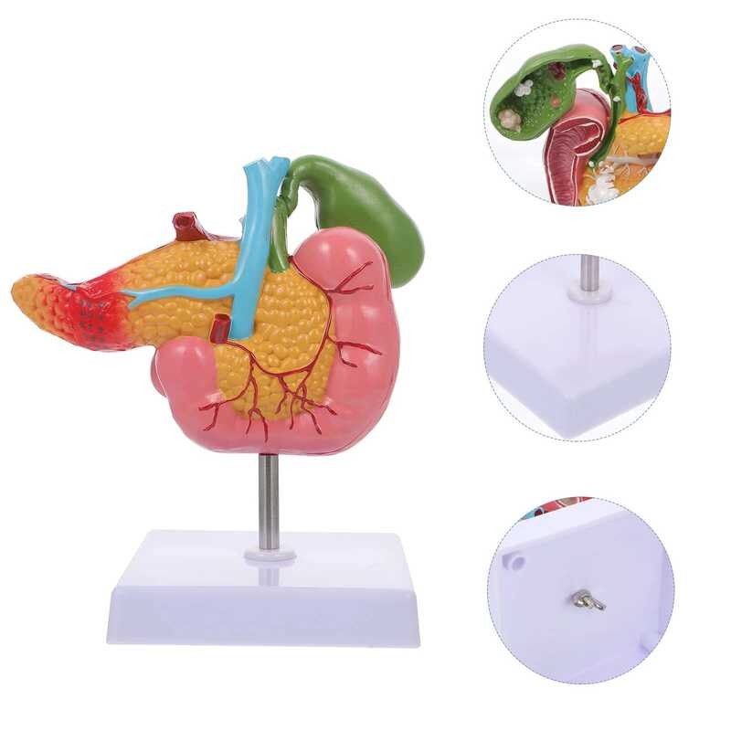 Pathological Model Of Gallbladder Models Spleen Lesions Pancreas ...