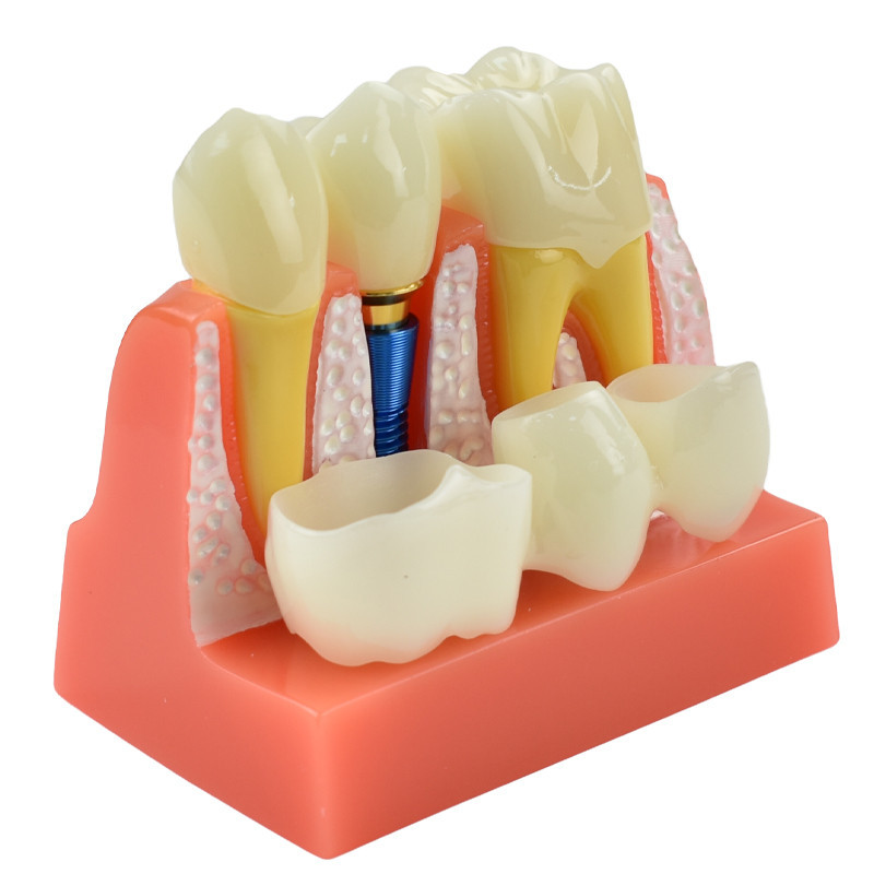 Dental Teach Crown Bridge Removable Model Porcelain Tooth Model Dental ...