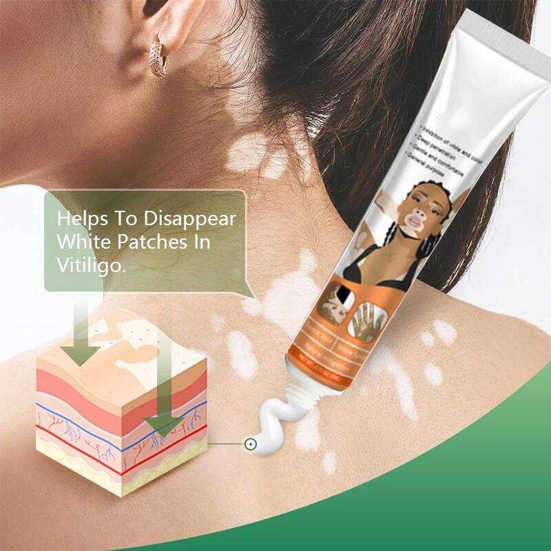 Photo inspiration: Eliminated Vitiligo Reference: Effectively Remove Vitiligo Ointment Ringworm White Spot Removal Skin