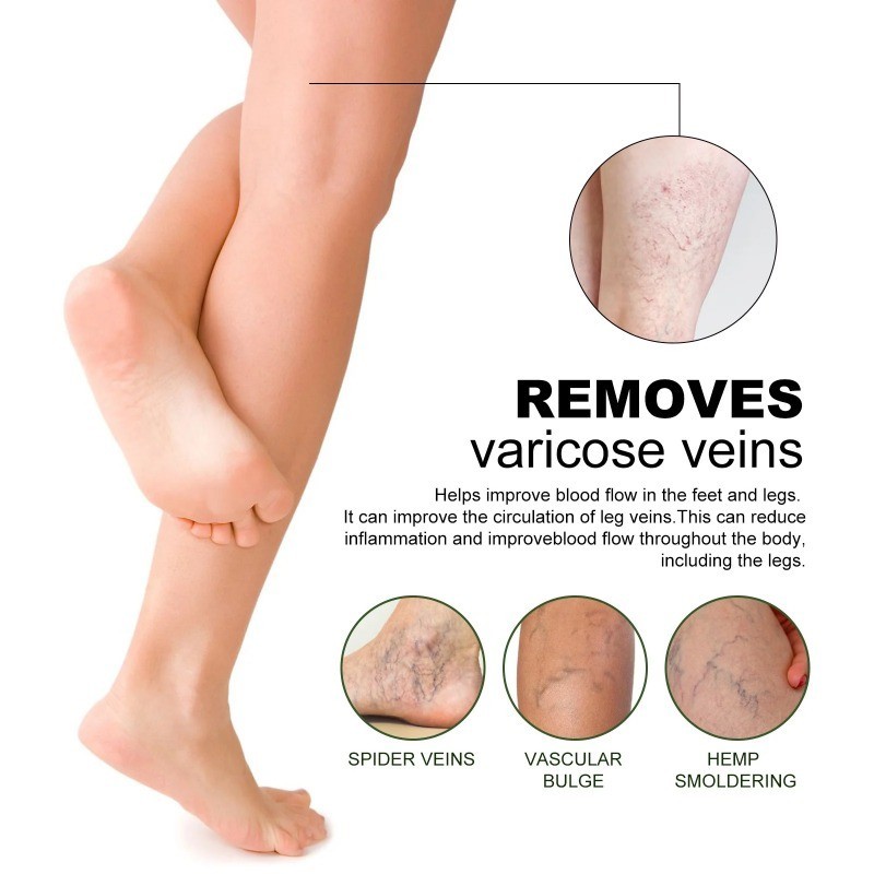 Varicose Veins Patch Removal Phlebitis Anti Swelling Smoothen Earthworm ...