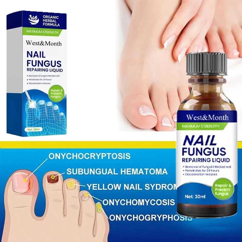 Nail Fungal Treatment Oil Foot Repair Essence Toe Fungus Removal Gel