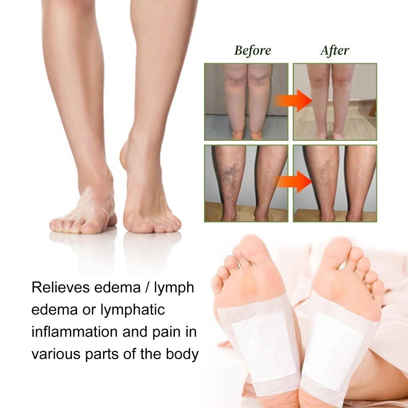 Varicose Veins Patch Removal Phlebitis Anti Swelling Smoothen Earthworm ...