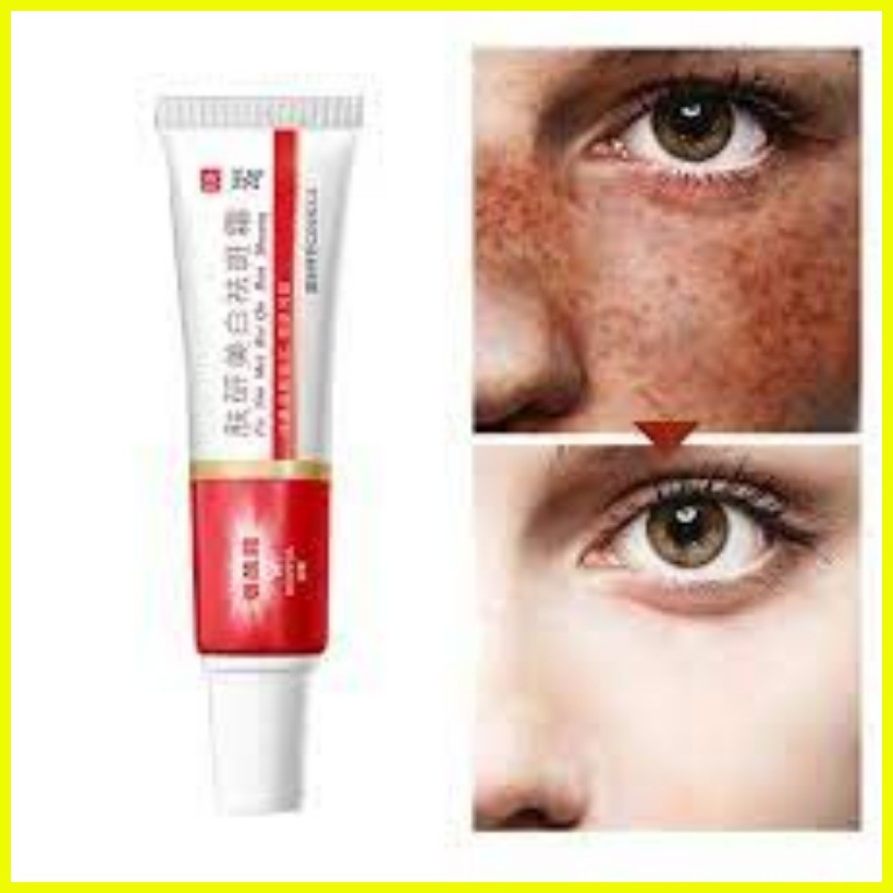 Melasma Cream Pekas Remover Collagen Japan Original Pekas Remover Cream ...