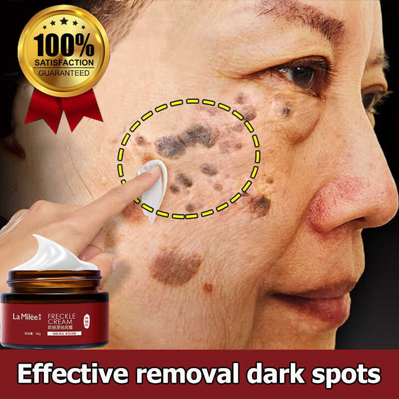 Japanese ♚ Original And Pekas Melasma From Japan Dark Spots Remover